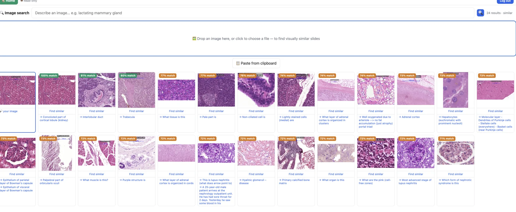 Study with Hannah semantic image search showing visually similar histology slides